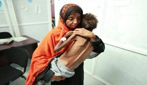 Yemen faces the worst famine in the world in 100 years due to the Anglo-American